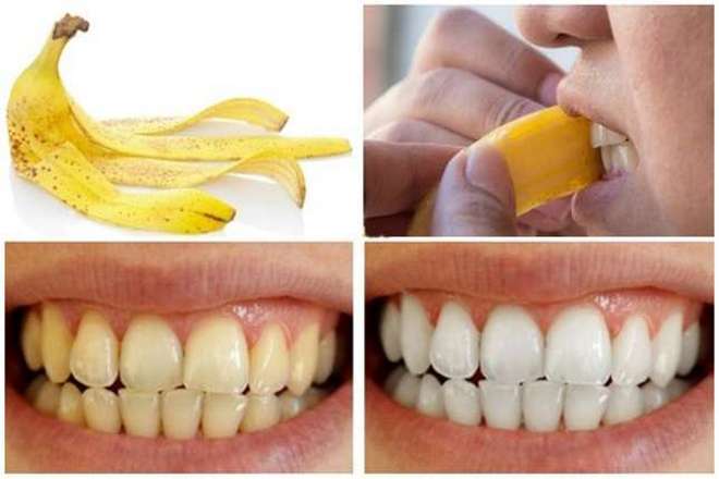 отбеливанию зубов с помощью банановой кожуры